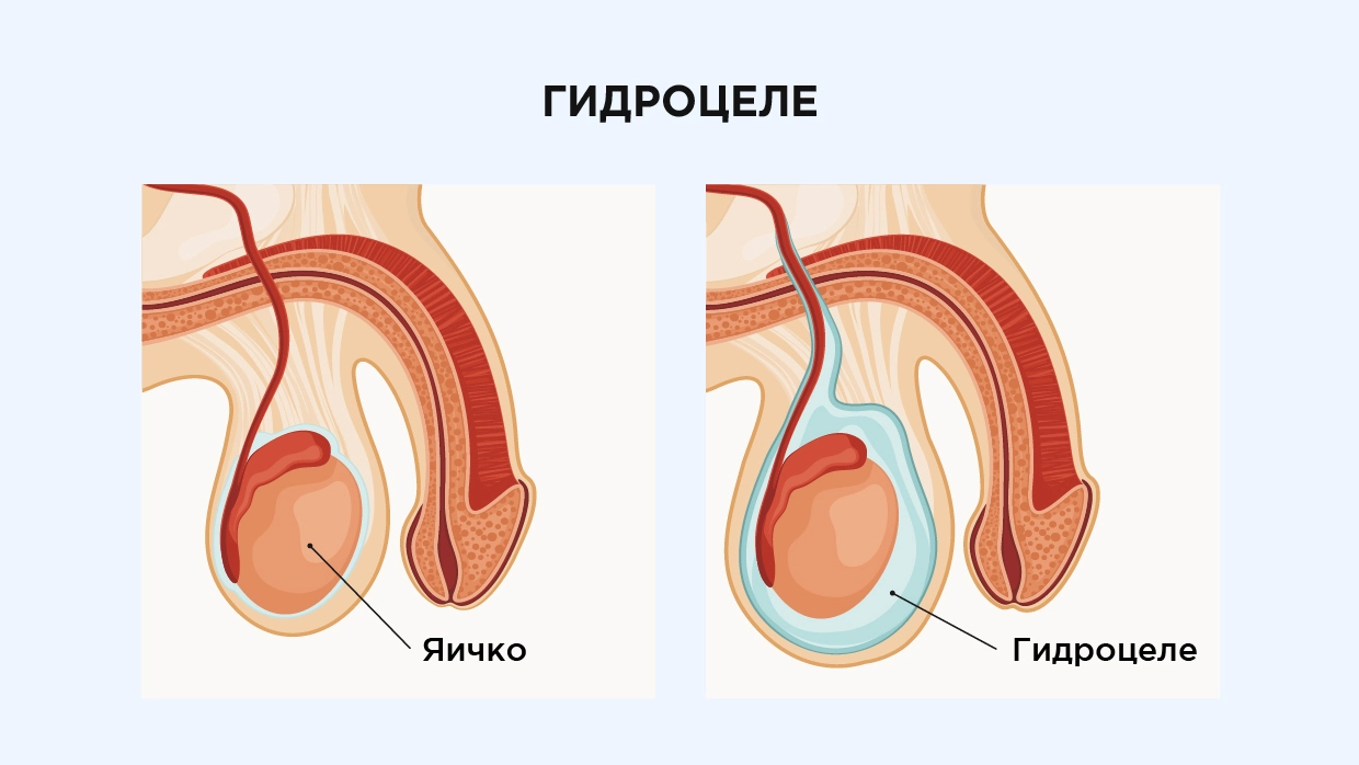 Как выглядит водянка яичка у ребенка: фото